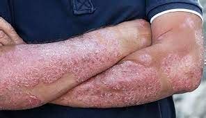 Can air pollution cause Psoriasis? Know what experts say - Times Applaud