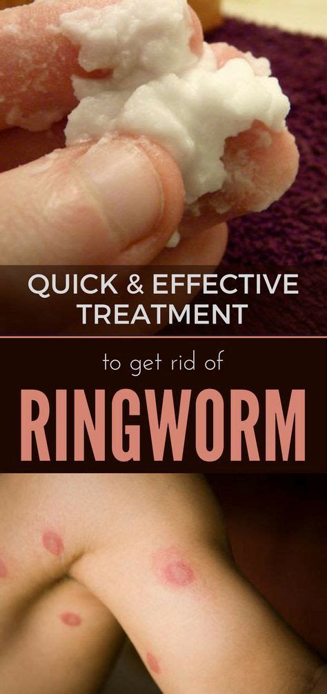 Quick and Effective Treatment to Get Rid of Ringworm | Home remedies ...