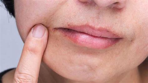 Cheilosis/Cheilitis: Causes, Symptoms, Diagnosis and How to Treat