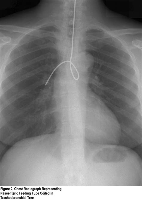 Nasogastric (NG) Tube Placement - Oxford Medical Education