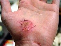 Wound healing - Simple English Wikipedia, the free encyclopedia