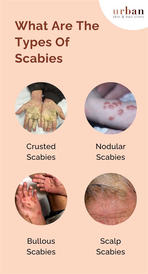 Scabies Types, Causes, Symptoms & Treatment | USHC