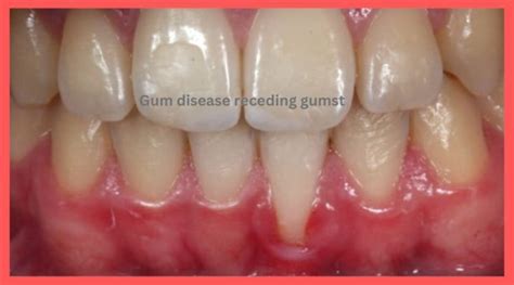 Everything about the gum disease receding gums treatment