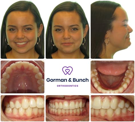 Invisalign Before And After Crowding