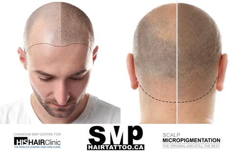 What is Scalp Micropigmentation Hair Tattoo? ️HAIRTATTOO.CA