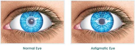 Astigmatism - A Common Condition of the Eye