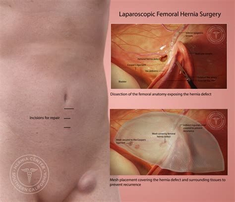 Femoral Hernia Repair in the Pasadena and Orange County CA Area