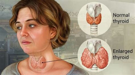 How To Get Rid Of Goiter - Dreamopportunity25