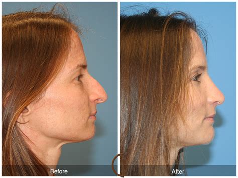 Septorhinoplasty in Long Beach, CA