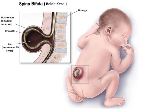 Spina Bifida Nedir? Neden Olur? Fizik Tedavisi - Doktor Fizik