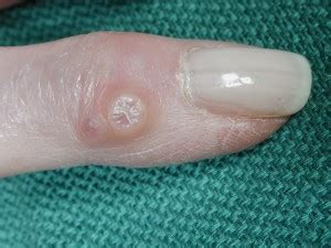 Digital Mucous Cyst (Ganglion on the Finger): Pictures, Treatment - eHealthStar