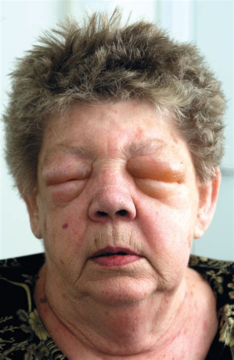 Angioedema – assessment and treatment | Tidsskrift for Den norske legeforening