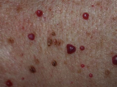 Cherry angioma: Symptoms, causes, and treatment