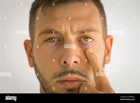 Liver disease skin hi-res stock photography and images - Alamy