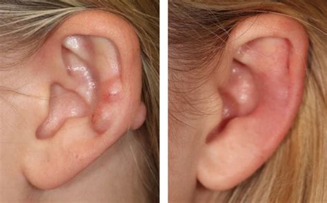 Management of Keloid Scars caused by Ear Piercings | Appearance Center