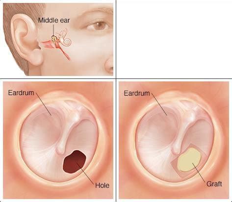 How To Heal A Ruptured Ear Drum - Signexercise2