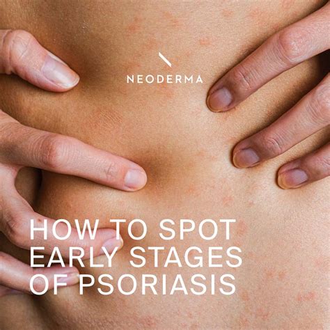 How to Spot Early Stages of Psoriasis? – NEODERMA