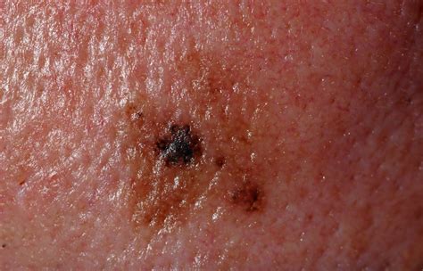 Melanoma in situ photos | Symptoms and pictures