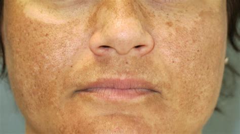 Melasma: Prevention and Treatment