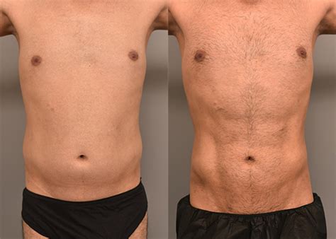 Lipo 360 with Liposculpture in Men Case #240