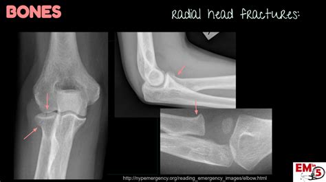 emDOCs.net – Emergency Medicine EducationEM in 5: Elbow Xrays - emDOCs.net - Emergency Medicine ...