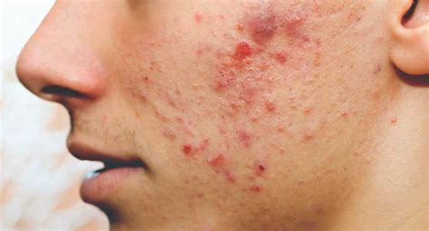 Neat Tips About How To Cure Pimples - Petertrade29