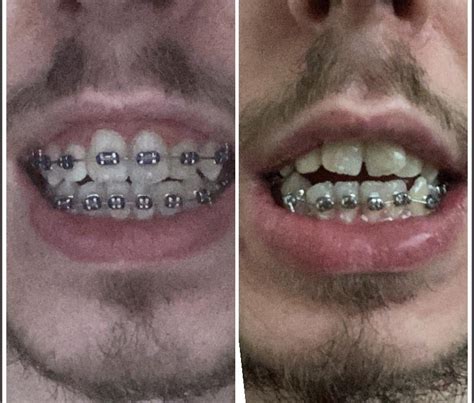 6 Months Braces Progress (1 month for upper braces) : r/braces