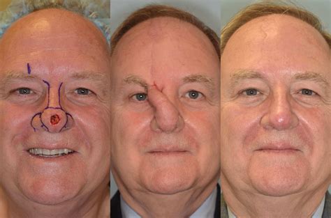 The Forehead Flap For Nasal Reconstruction Facial Pla - vrogue.co