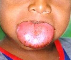 👉 Macroglossia - Pictures, Causes, Symptoms, Treatment (December 2021)