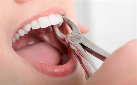 Is a Tooth Extraction Painful? A Dentist Weighs In