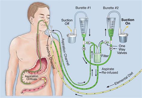 SSAT - Repeated Re-Cycling of Aspirated Digestive Juices to Enzymatically Cleanse Feeding ...