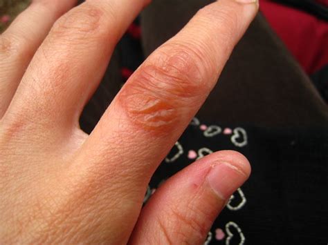 Second degree burn- Day 6 | Did not pop it. Blister is there… | Flickr
