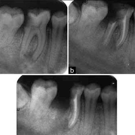 (PDF) Hemisection as a Conservative Management of Grossly Carious Permanent Mandibular First Molar