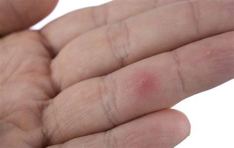 The Best Way to Remove a Splinter | Men's Health