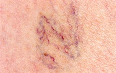 Broken capillaries on legs pictures | Symptoms and pictures