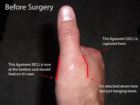 Train, Race, Rest, Repeat: Ruptured UCL / Torn RCL - Ouch!