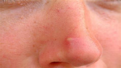 Basal cell carcinoma : Cancer that begins with a pimple - TrendRadars India