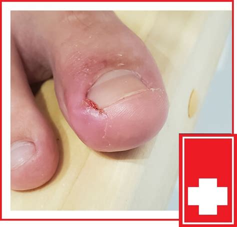 Ingrown Toenail Removal/Treatments | Ingrown Toenail Specialist Near Me ...