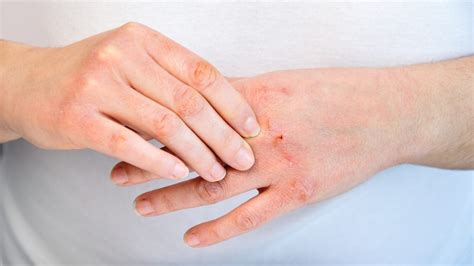 [10000印刷√] eczema causes 129239-Eczema causes and treatment