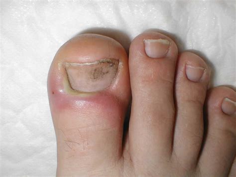 Paronychia special cream toe toenails to remove granulation redness and swelling anti ...