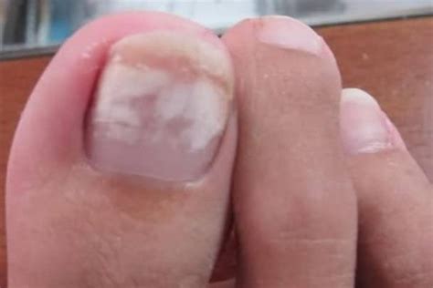 What Are White Spots On Toenails - Design Talk