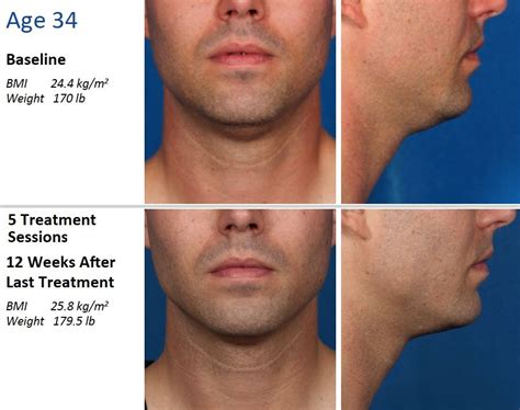 Kybella Before And After Male