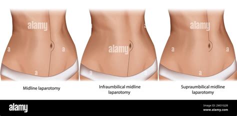 Abdominal midline incision. Incision sites of midline laparotomies ...