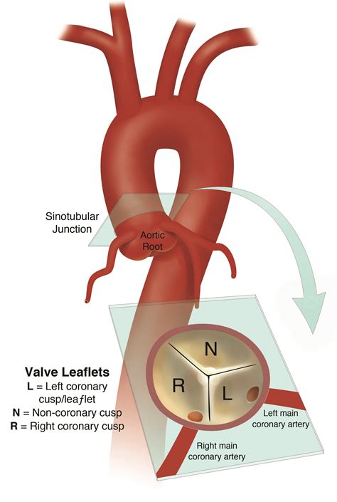 Aorta Anatomy | UF Health Aortic Disease Center|Diseases & Treatment ...