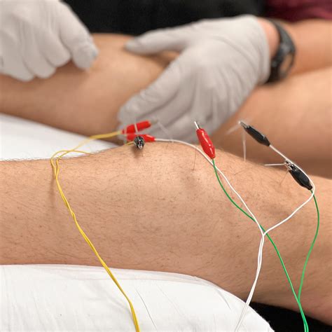 How Dry Needling Therapy Can Help Chronic Pain – MS Physical Therapy