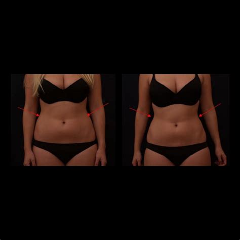 Liposuction Alternatives Treatment | Dermedica | Vanquish Fat Reduction