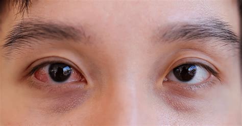 Pink eye vs. Allergies: how to tell the difference?