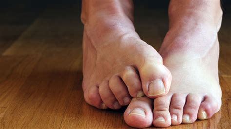 Treat athlete’s foot early to avoid infection | Fox News
