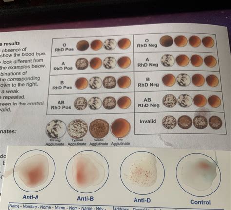 Help analyzing at-home blood type test? : DiagnoseMe