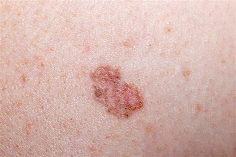 Leukemia Symptoms Skin